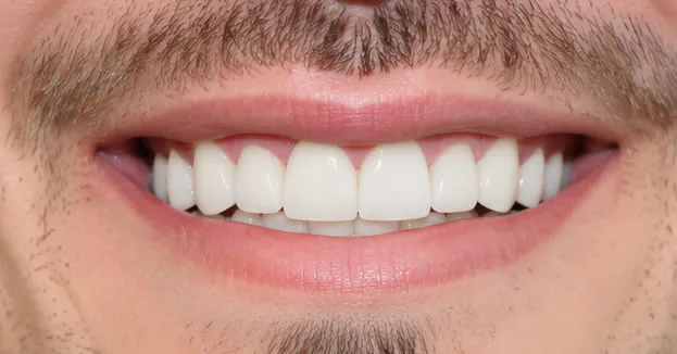 After full mouth restoration mouth