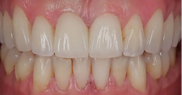 close up after dental bridge