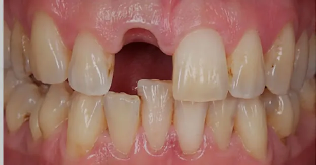 close up before dental bridge
