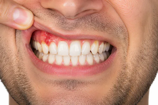 close up of gum inflamation
