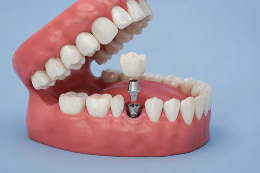 single tooth dental implant