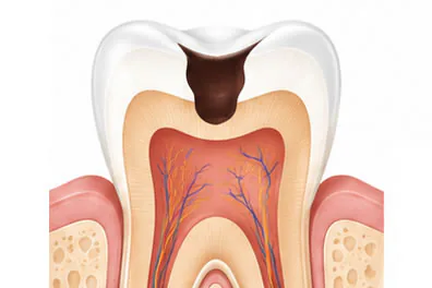 tooth cavity illustration